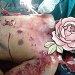 Babinsa Kijang Kota Bintan Evakuasi Korban Ledakan Bom Ikan